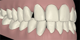 Invisalign Implantate nach Behandlungsende im ClinCheck links