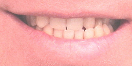 Implantat-Invisalign-Patient vor der Behandlung