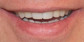 Implantat-Invisalign-Patient nach der Behandlung