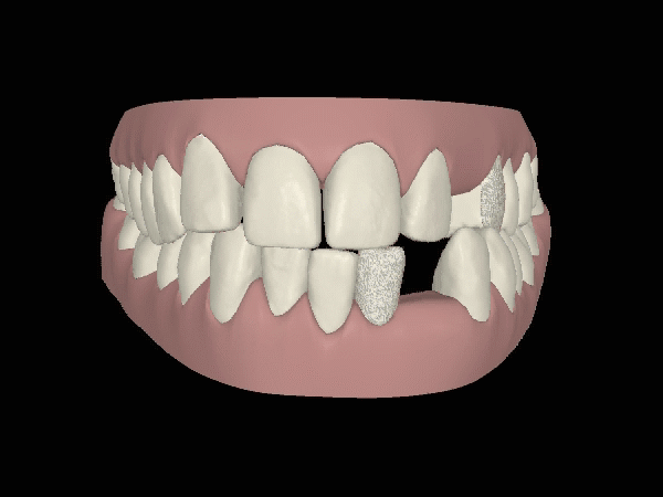 Behndlunsgssimulation Implantat-Invisalign