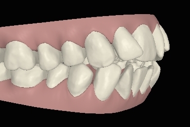 ClinCheck Engstand vor Invisalign-Behandlung links