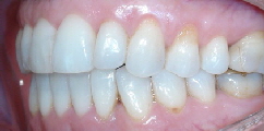 invisalign