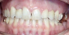 Mit Frontzahnimplantat