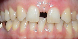 Frontzahnimplantat 8