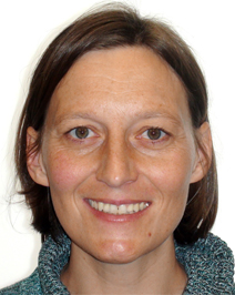 Mit Frontzahnimplantat nach Aligner behandlung