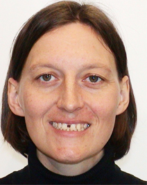 Ohne Frontzahnimplantat mit Zahnlücke