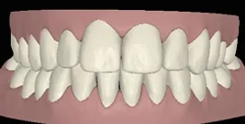 Nach Gesichtschirurgie und Invisalign Therapie digitale frontale Ansicht
