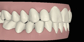 Nach Gesichtschirurgie und Invisalign Therapie digitale rechte seite