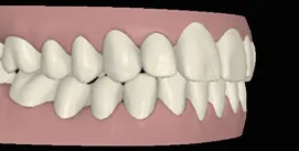 Nach Gesichtschirurgie und Invisalign Therapie digitale rechte seite