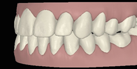 Nach Gesichtschirurgie und Invisalign Therapie digitale linke seite