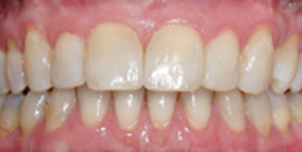 Nach Gesichtschirurgie und Invisalign Therapie Patient frontal ansicht