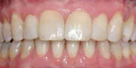 Nach Gesichtschirurgie und Invisalign Therapie Patient frontal ansicht