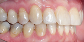 Nach Gesichtschirurgie und Invisalign Therapie Patient rechte Seite