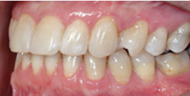 Nach Gesichtschirurgie und Invisalign Therapie Patient linke Seite