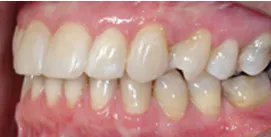 Nach Gesichtschirurgie und Invisalign Therapie Patient linke Seite