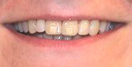 Nach Gesichtschirurgie