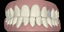 Clincheck mit Implantat nach Invisalign frontal