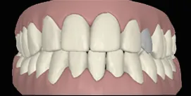 Clincheck mit Implantat nach Invisalign frontal