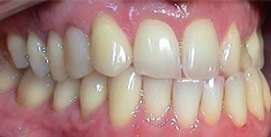 Patient Kreuzbiss frontal vor Implantat