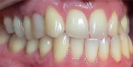 Patient Kreuzbiss frontal vor Implantat