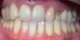 Patient Kreuzbiss frontal vor Implantat