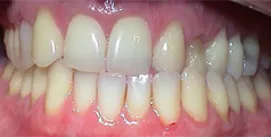 Patient Kreuzbiss frontal vor Implantat