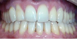 Patient mit Implantat nach Invisalign frontal