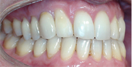 Patient mit Implantat nach Invisalign rechte Seite