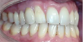 Patient mit Implantat nach Invisalign rechte Seite