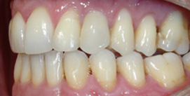 Patient mit Implantat nach Invisalign linke Seite