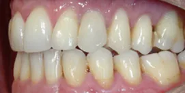 Patient Kreuzbiss frontal vor Implantat linke seite
