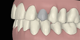 Clincheck mit Implantat nach Invisalign linke Seite