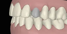 Clincheck mit Implantat nach Invisalign linke Seite