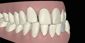 Digitaler Kreuzbiss frontal vor Implantat rechte Seite