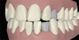 Digitaler Kreuzbiss frontal vor Implantat linke Seite