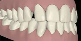 Clincheck mit Implantat nach Invisalign rechte Seite
