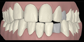 Digitaler Kreuzbiss frontal vor Implantat