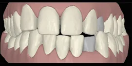 Digitaler Kreuzbiss frontal vor Implantat