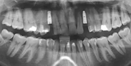 Implantate ersetzen Eckzähne, Röntgenbild