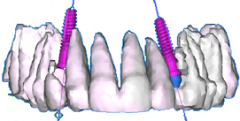 Implantat-Planung im CT mit Implant