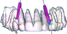 Implantat-Planung im CT mit Implant
