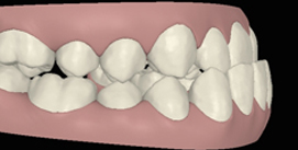 Digitale Ansicht vor Kieferkorrektur rechte Seite