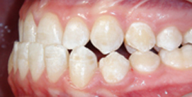 Vor Kieferkorrektur Patient linke Seite