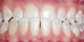 Vor Kieferkorrektur Patient frontal Ansicht