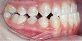 Vor Kieferkorrektur Patient rechte Seite