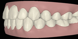 Nach Invisalign und Kieferkorrektur digitale Ansicht linke Seite
