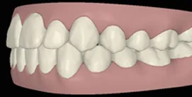 Nach Invisalign und Kieferkorrektur digitale Ansicht linke Seite