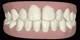 Nach Invisalign und Kieferkorrektur digitale frontale Ansicht