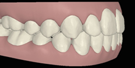 Nach Invisalign und Kieferkorrektur digitale Ansicht linke Seite