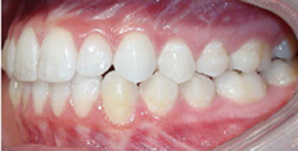 Nach Invisalign und Kieferkorrektur Patient linke Seite